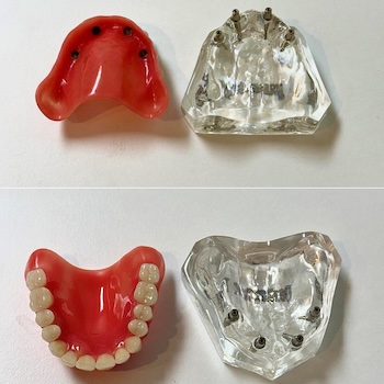 Dental Implants