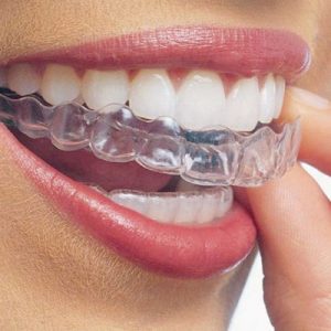 Invisalign