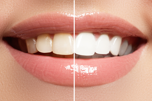 Whitening