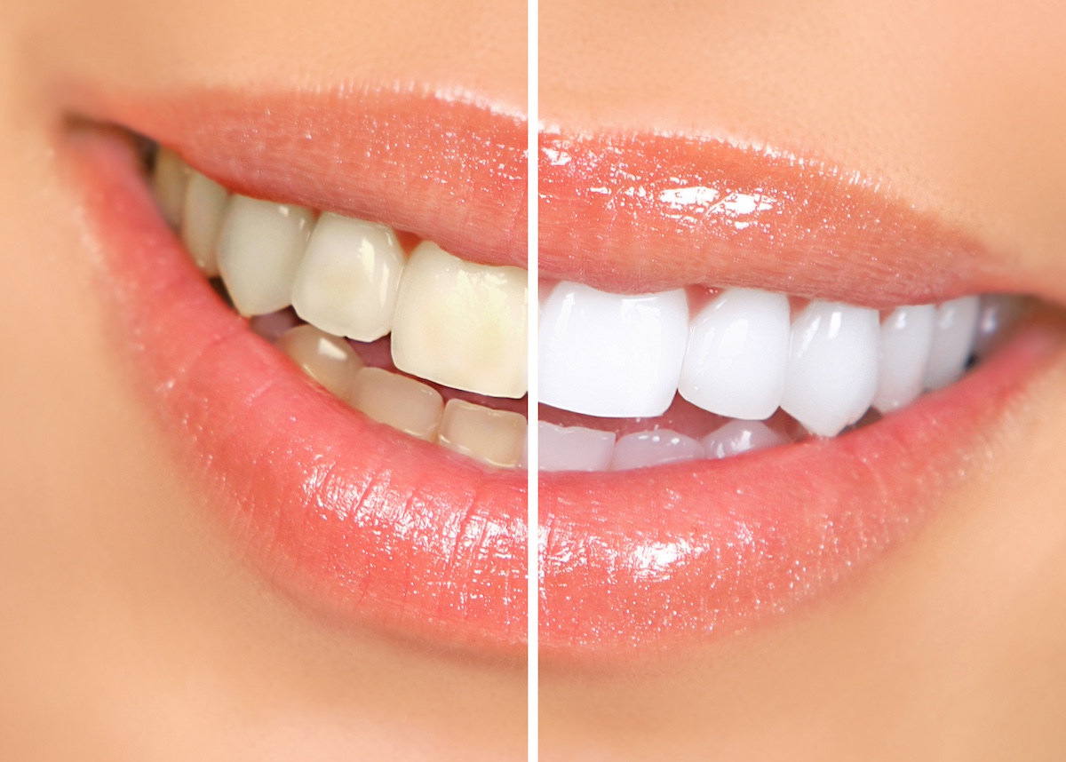 Teeth Whitening vs. Veneers: Which One Is Best?